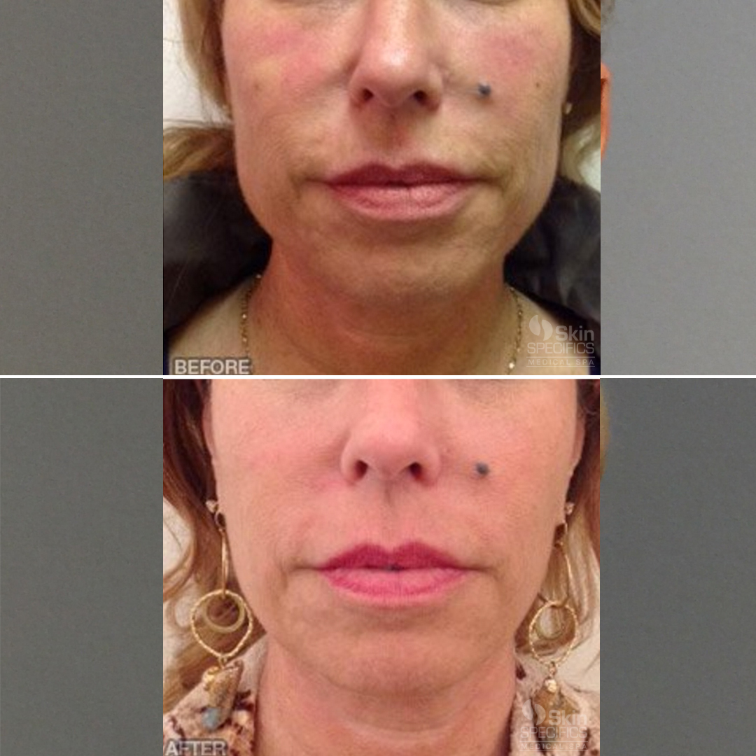 Facial reshaping/masseter reduction with botox by anusha dahan at skin specifics med spa in los angeles