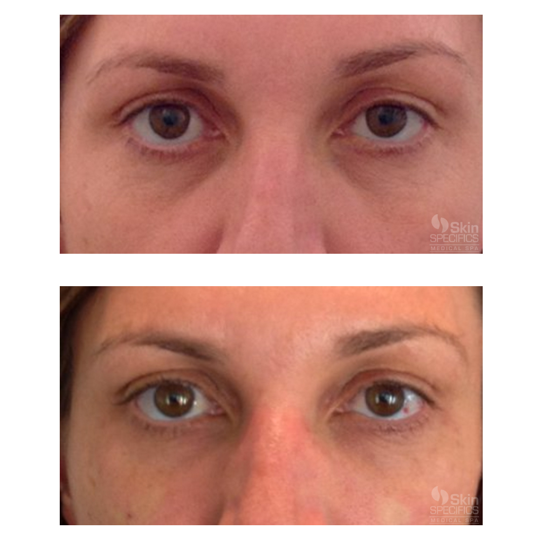 Tear trough-dark circles with belotero balance by anusha dahan at skin specifics med spa in los angeles