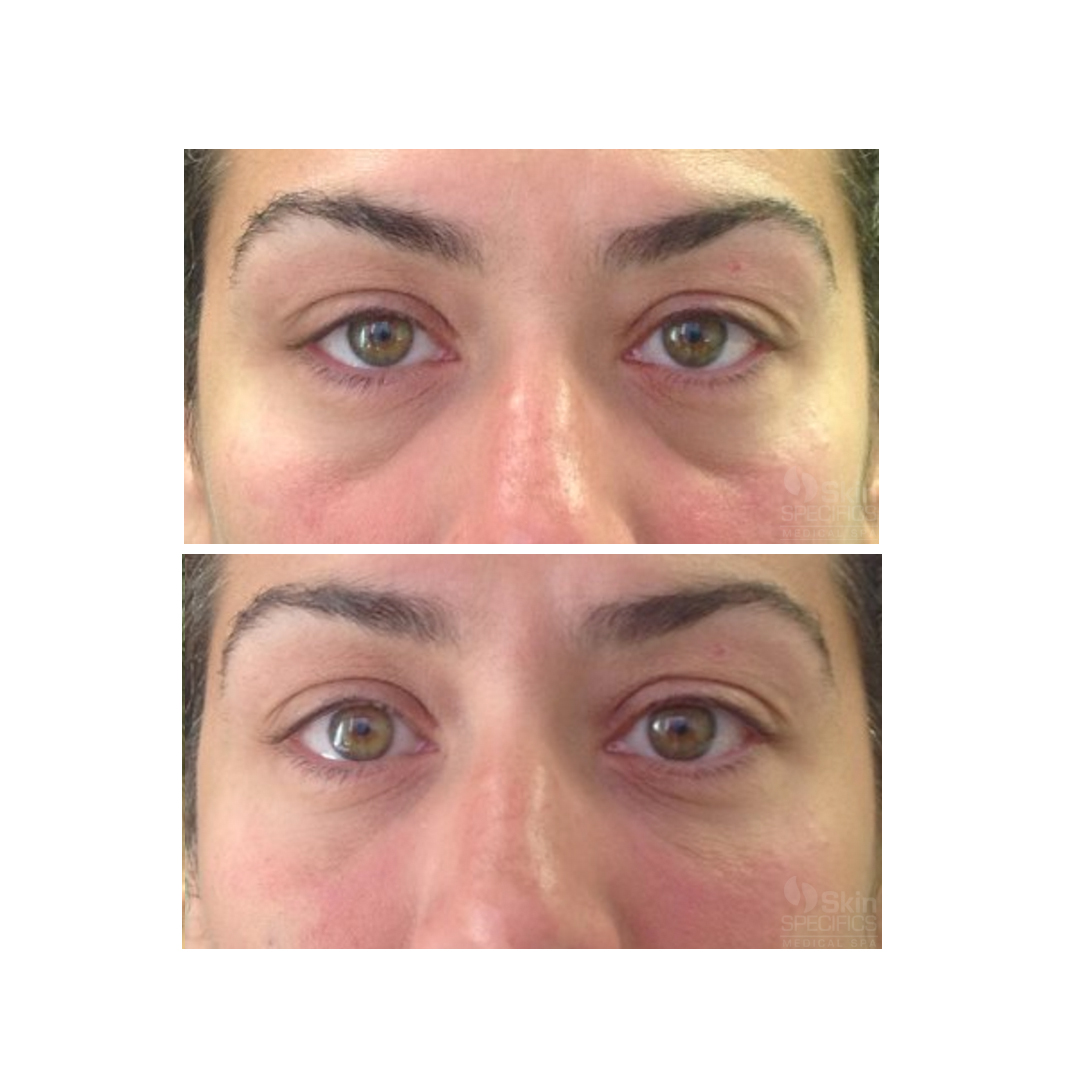 Tear trough-Dark circles with belotero balance by anusha dahan at skin specifics medical spa in los angeles