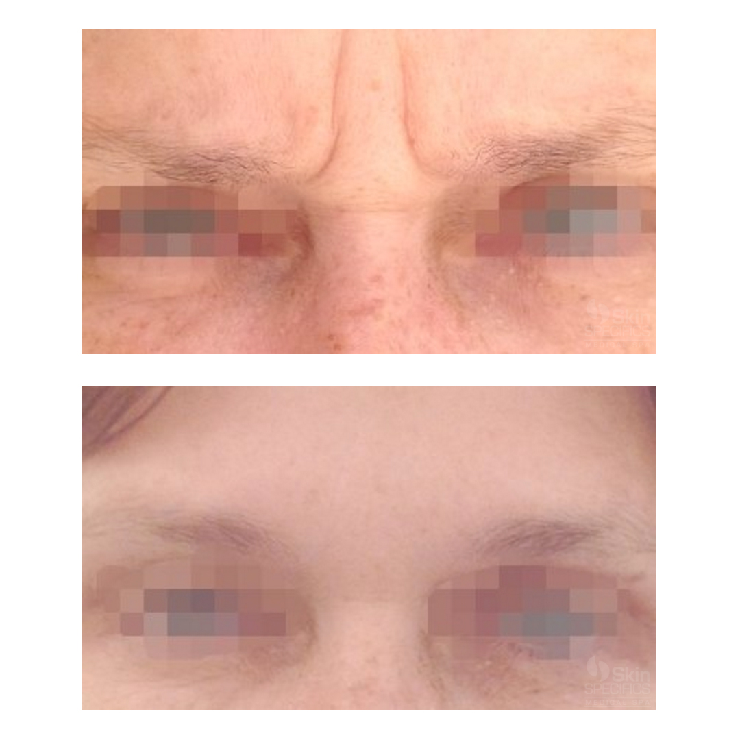11 lines or frown lines treated with botox by anusha dahan at skin specifics medical spa in los angeles
