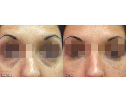 Tear Trough-Dark circles with restylane by anusha dahan at skin specifics med spa in los angeles