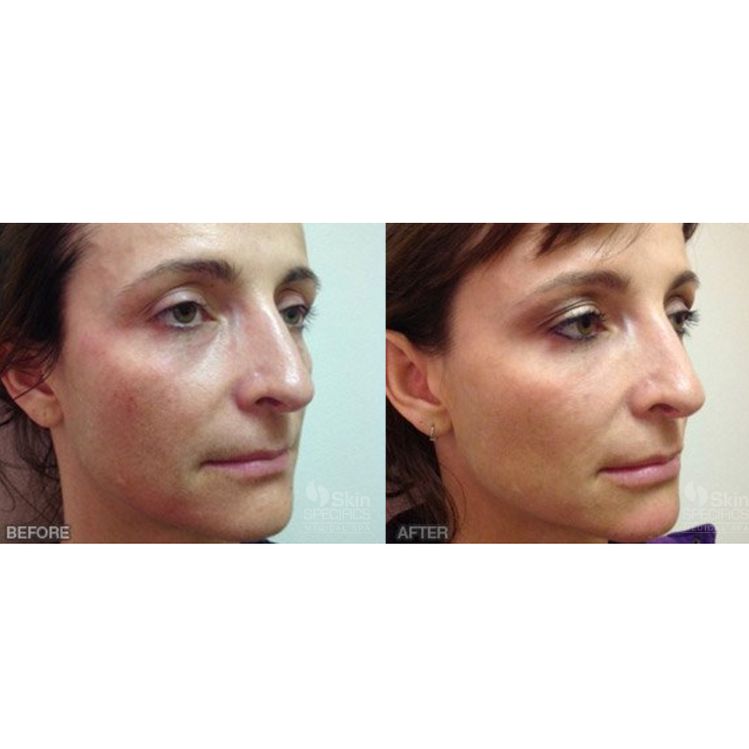 Tear trough- dark circles with juvederm and botox to upper face by anusha dahan at skin specifics med spa in la