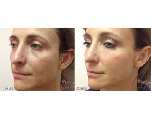 Tear trough- dark circles with juvederm and botox to upper face by anusha dahan at skin specifics med spa in la