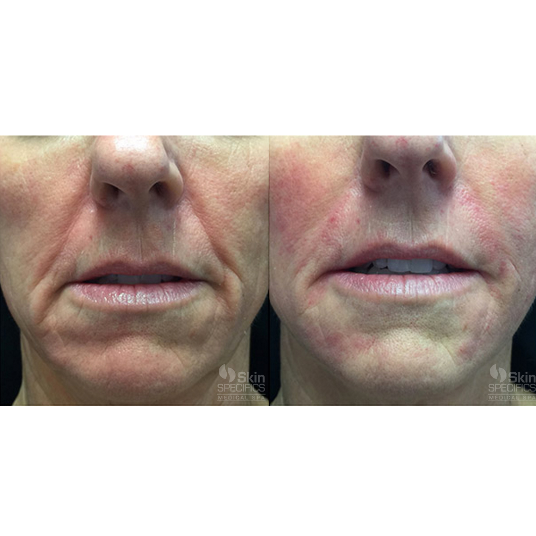 Lower face rejuvenation with juvederm by anusha dahan at skin specifics med spa in los angeles