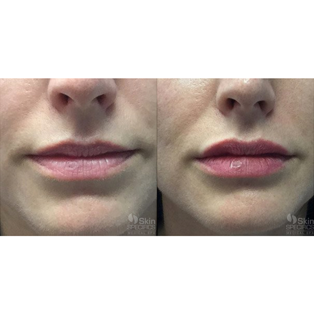 Lip enhancement - augmentation with juvederm by anusha dahan at skin specifics med spa in los angeles