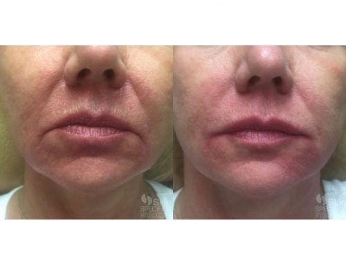 Juvederm before and after by anusha dahan at skin specifics med spa in los angeles
