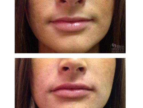 Lip augmentation with Juvederm before and after by anusha dahan at skin specifics med spa in los angeles