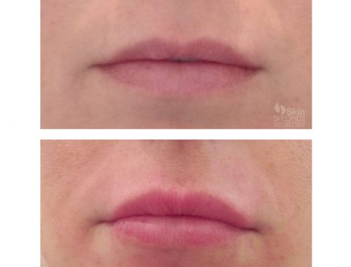 Lip augmentation with Juvederm before and after by anusha dahan at skin specifics med spa in los angeles