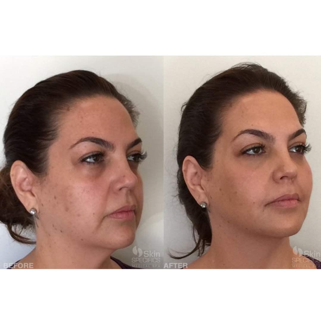 Weight loss treatment with juvederm voluma before and after by anusha dahan at skin specifics med spa in los angeles