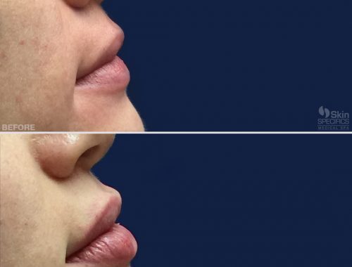 lip augmentation with juvederm before and after by anusha dahan at skin specifics med spa in los angeles