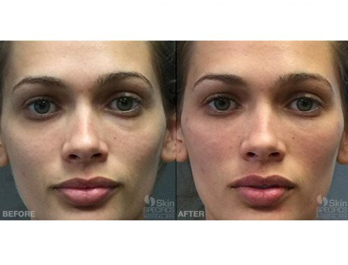cheek enhancement with juvederm before and after by anusha dahan at skin specifics med spa in los angeles