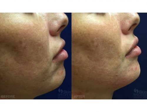 chin treatment with juvederm before and after by anusha dahan at skin specifics med spa in los angeles