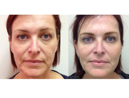 total face rejuvenation with juvederm and botox before and after by anusha dahan at skin specifics med spa in los angeles