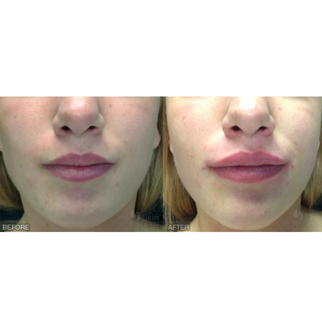 lip augmentation with juvederm before and after by anusha dahan at skin specifics med spa in los angeles