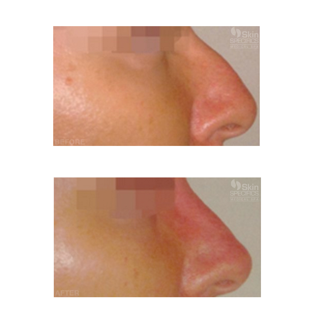 nose reshaping with juvederm before and after by anusha dahan at skin specifics med spa in los angeles