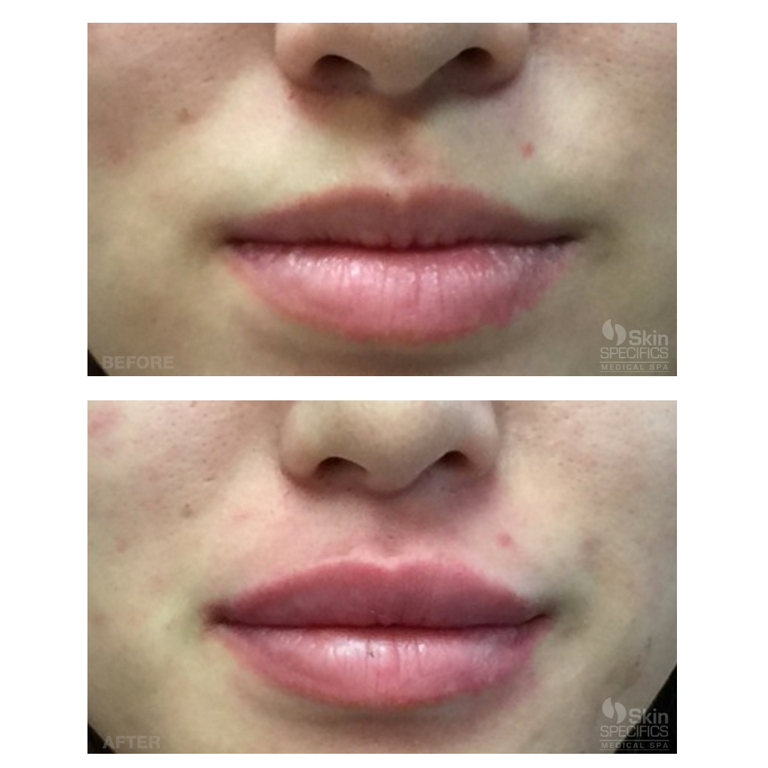 Juvederm In The Lips Before And After 1426