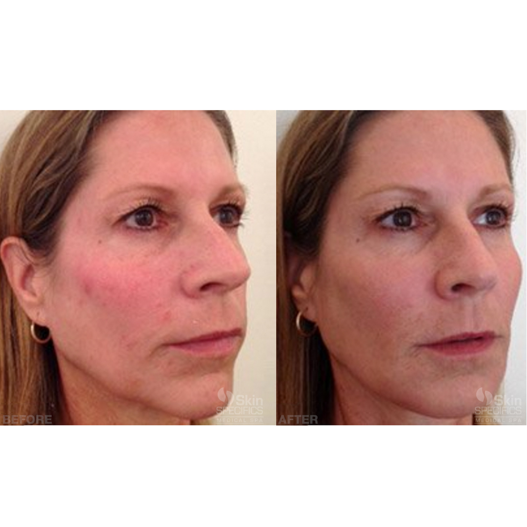 mid face and cheek enhancement with radiesse before and after by anusha dahan at skin specifics med spa in los angeles