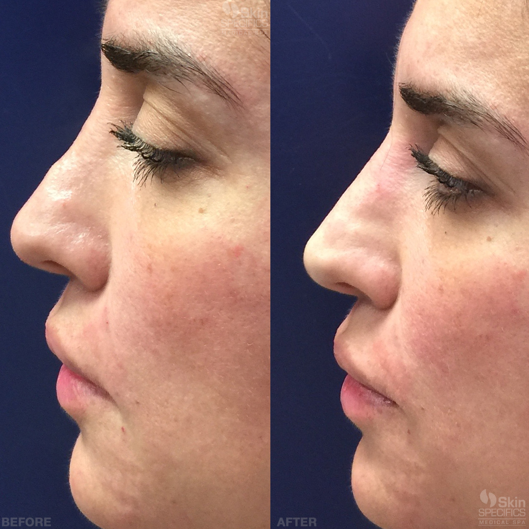 nose reshaping with juvederm before and after by anusha dahan at skin specifics med spa in los angeles