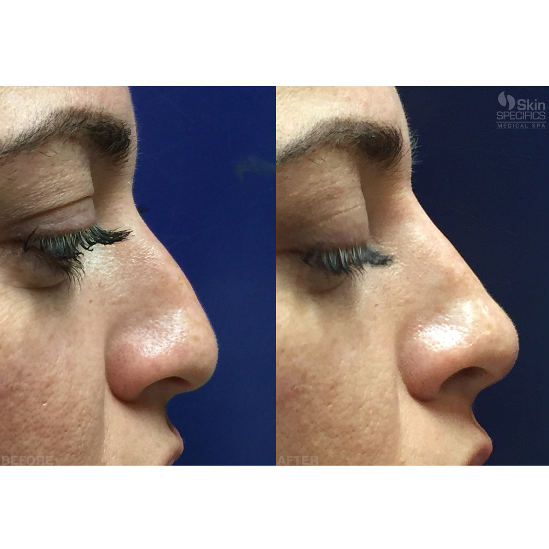 nose reshaping before and after by anusha dahan at skin specifics med spa in los angeles