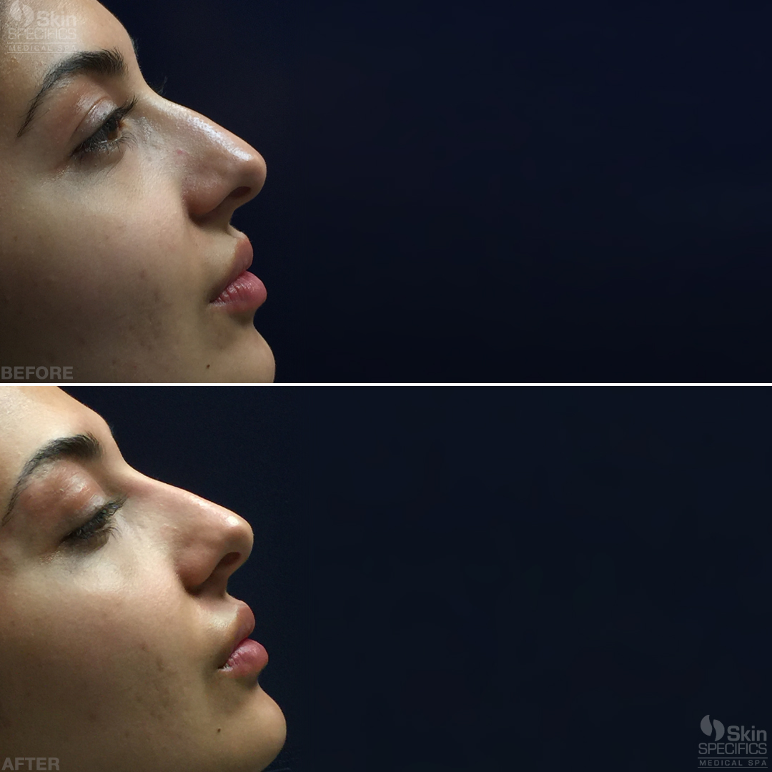 nose reshaping with retylane lyft before and after by anusha dahan at skin specifics med spa in los angeles