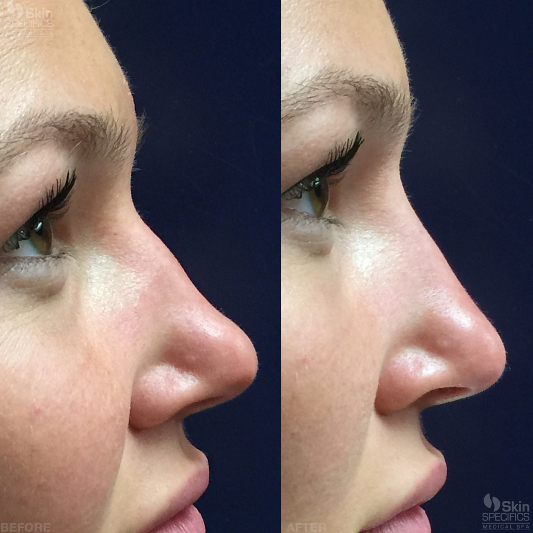 nose reshaping with juvederm ultra plus xc before and after by anusha dahan at skin specifics med spa in los angeles