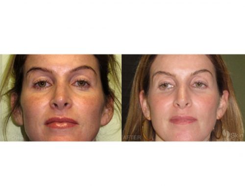 sun damage ipl photofacial treatment before and after by anusha dahan at skin specifics med spa in los angeles