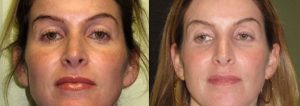 sun_damage_ipl_photofacial