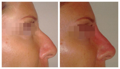 Nose reshaping with Juvederm