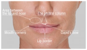 Designing lips with botox and fillers using cannula needles