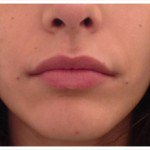 Juvederm Before & After Patient #9307