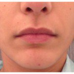 Juvederm Before & After Patient #9307