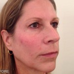 Radiesse Before & After Patient #9184