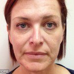 Juvederm Before & After Patient #9243