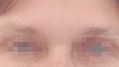 Forehead Frown Lines Before Patient 3 Los Angeles