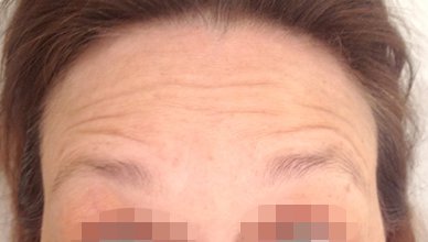Forehead Horizontal Frown Lines Before Patient 1