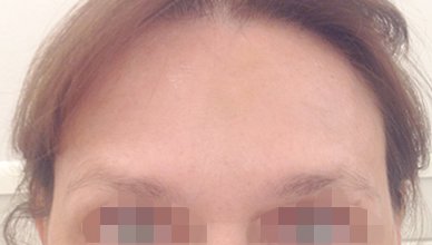 Horizontal Frown Lines Forehead After Patient 1