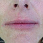 Juvederm Before & After Patient #9264