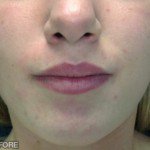 Juvederm Before & After Patient #9261