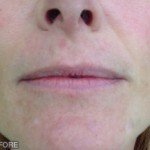 Juvederm Before & After Patient #9264