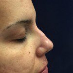 Nose Reshaping Before & After Patient #9704