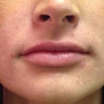 Juvederm Before & After Patient #9309