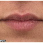 Lip Fillers Before & After Patient #10106
