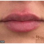 Lip Fillers Before & After Patient #10106
