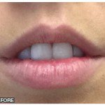 Lip Fillers Before & After Patient #10113