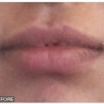 Lip Fillers Before & After Patient #10116