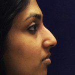 Nose Reshaping Before & After Patient #10333