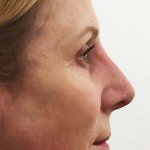 Nose Reshaping Before & After Patient #10401