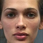 Juvederm Before & After Patient #10650
