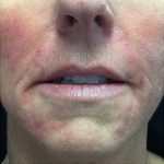 Juvederm Before & After Patient #10656