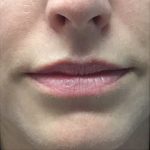 Juvederm Before & After Patient #10659